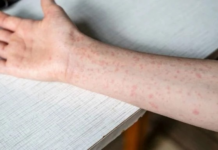 Three cases of measles imported from Michoacán to Morelos confirmed